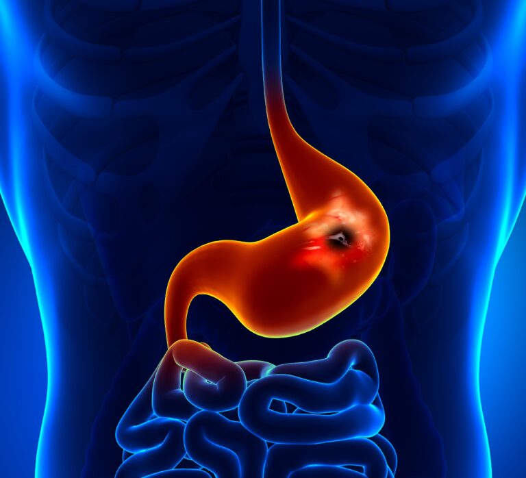 Gastric Ulcers: What You Should Know in 2024